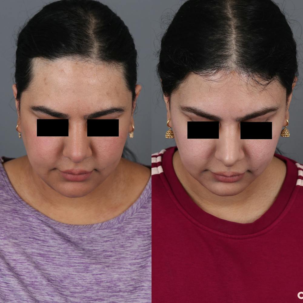 Forehead Reduction Before & After Gallery - Patient 307060 - Image 3