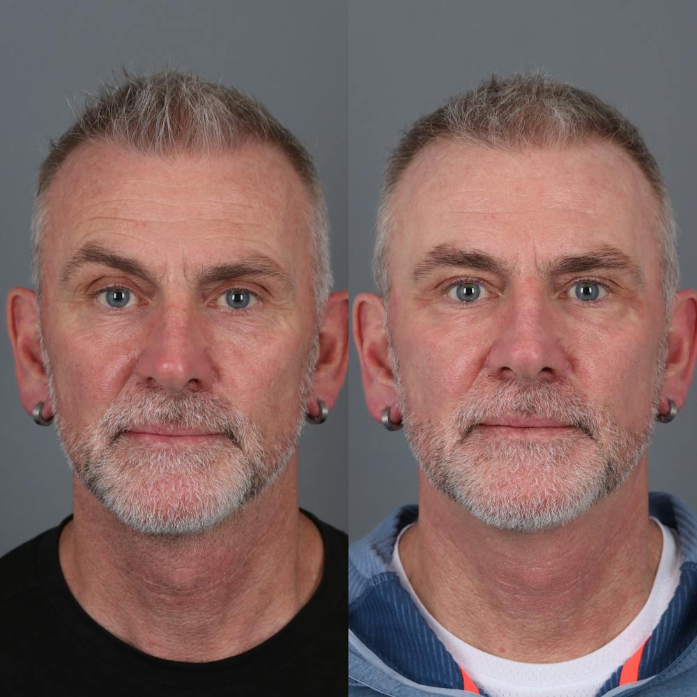 Laser Skin Resurfacing Before & After Gallery - Patient 284709 - Image 1