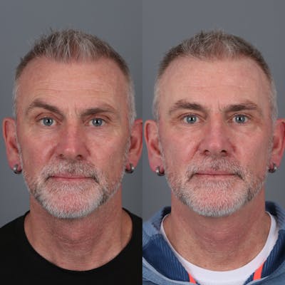 Laser Skin Resurfacing Before & After Gallery - Patient 284709 - Image 1