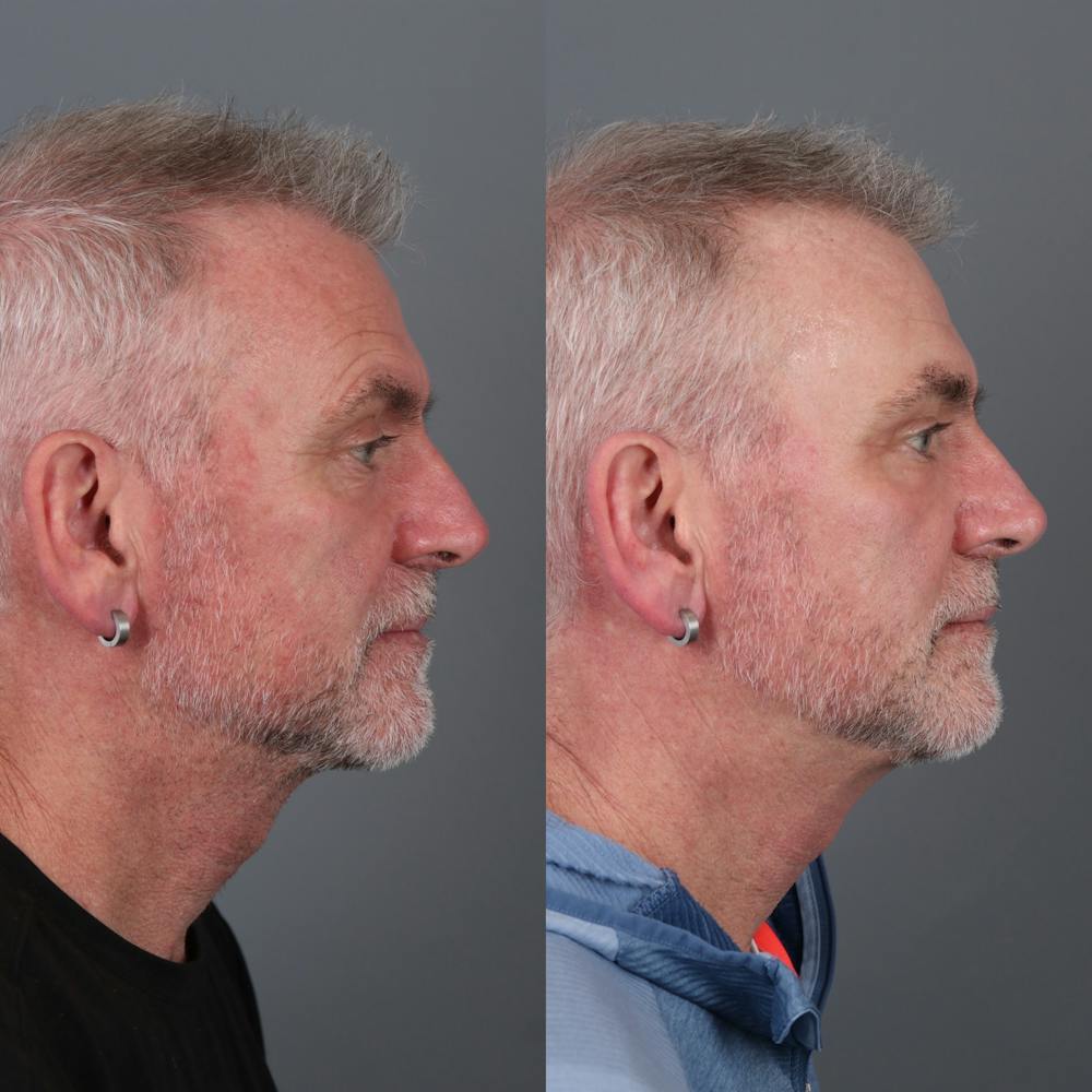 Laser Skin Resurfacing Before & After Gallery - Patient 284709 - Image 3