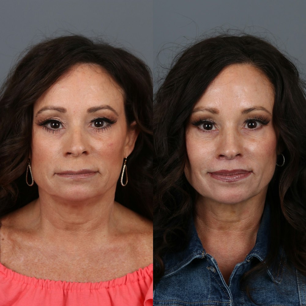 Lip Lift in Portland Before & After Photos