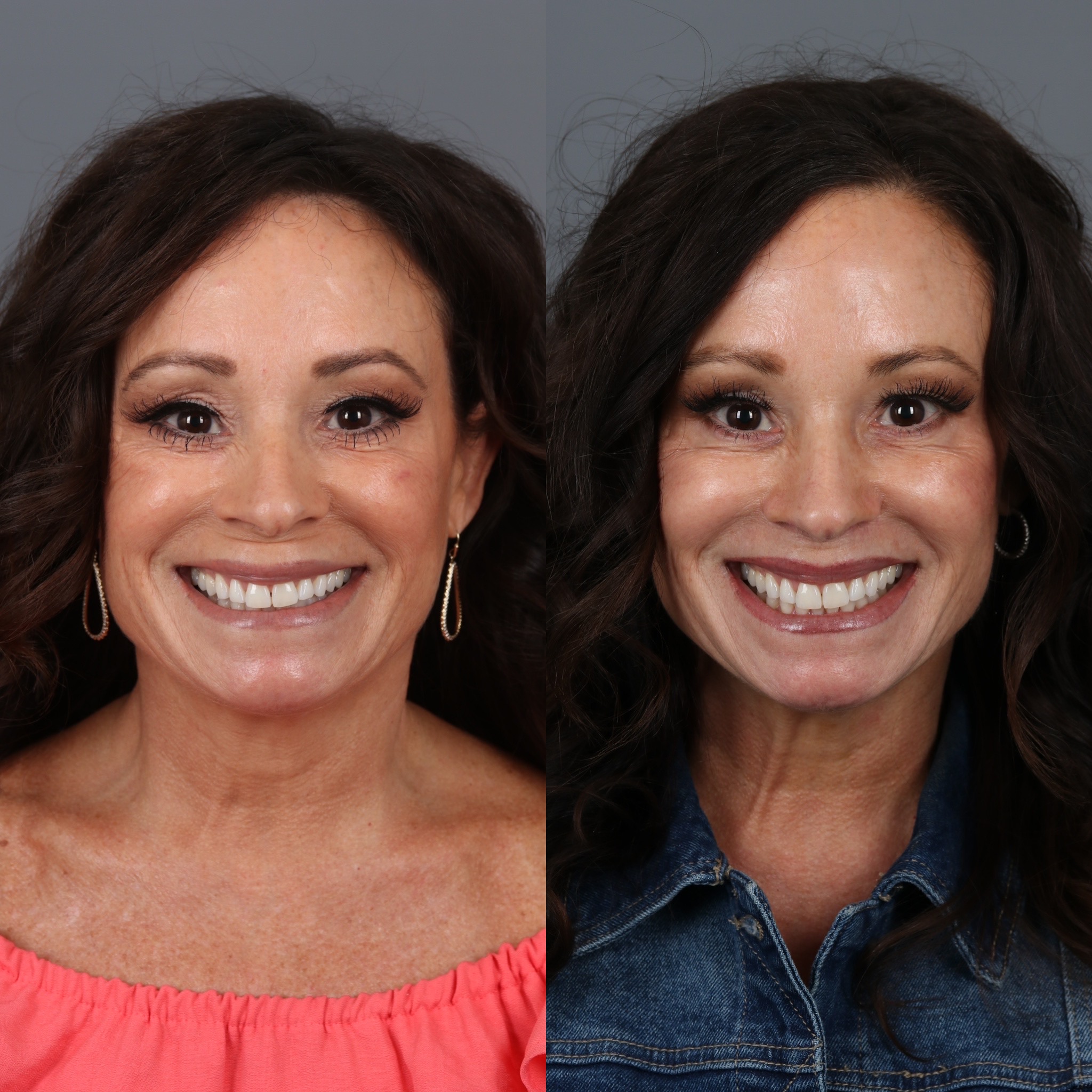 Patient 331769 | Lip Lift Before & After Photos | The Vila