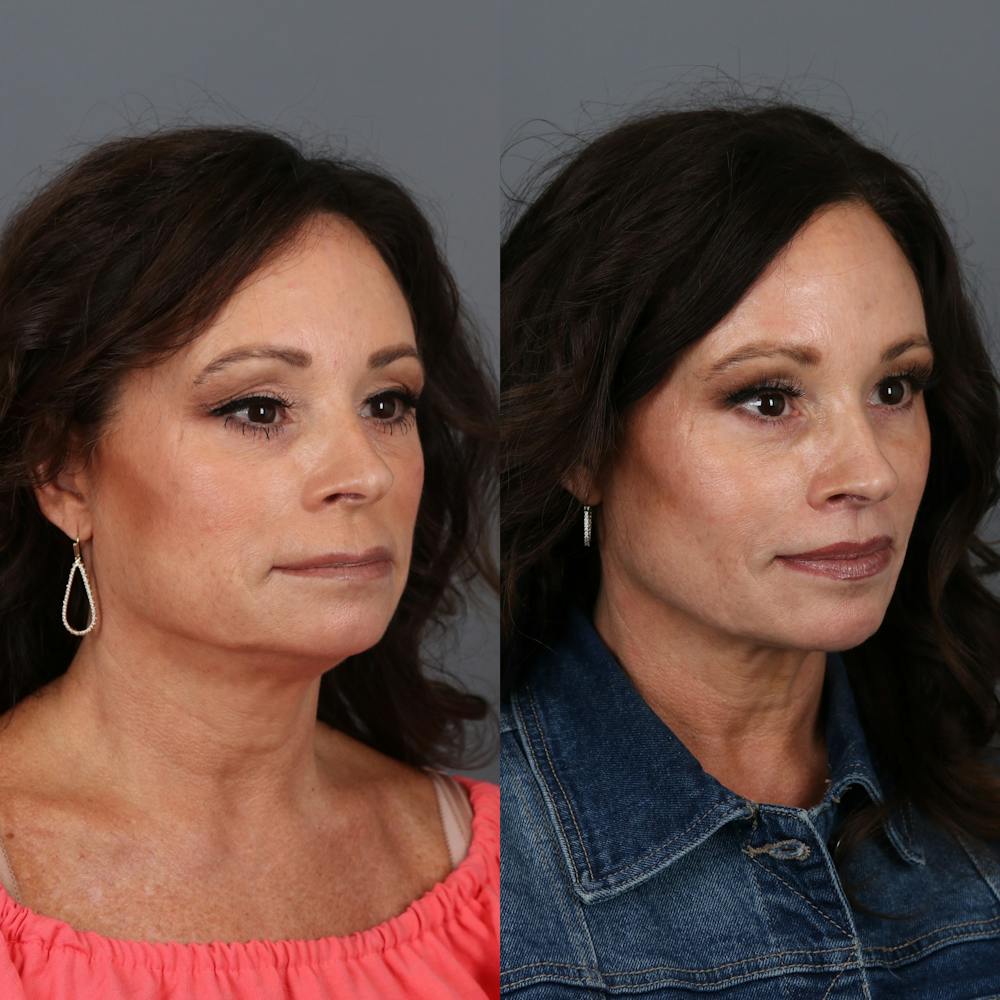 Lip Lift Before & After Gallery - Patient 331769 - Image 4