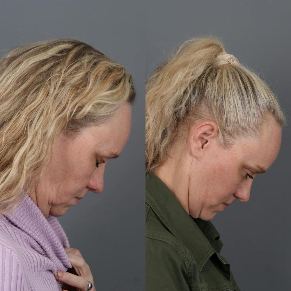 Face & Neck Lift Before & After Gallery - Patient 405742 - Image 3