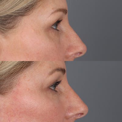 Lower Blepharoplasty Before & After Gallery - Patient 225941 - Image 4