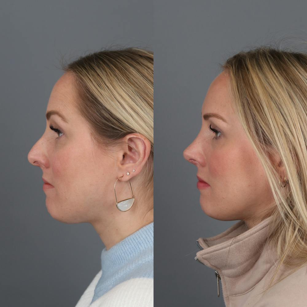 Rhinoplasty Before & After Gallery - Patient 350019 - Image 1