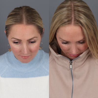 Rhinoplasty Before & After Gallery - Patient 350019 - Image 6