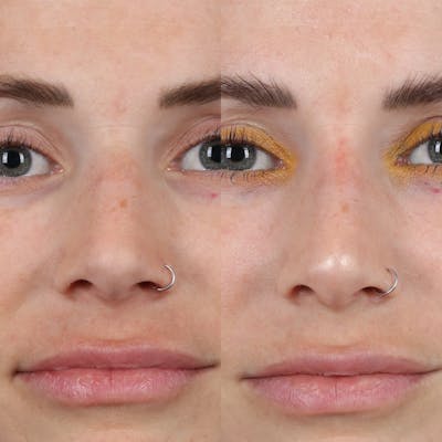 Liquid Rhinoplasty Before & After Gallery - Patient 371112 - Image 2