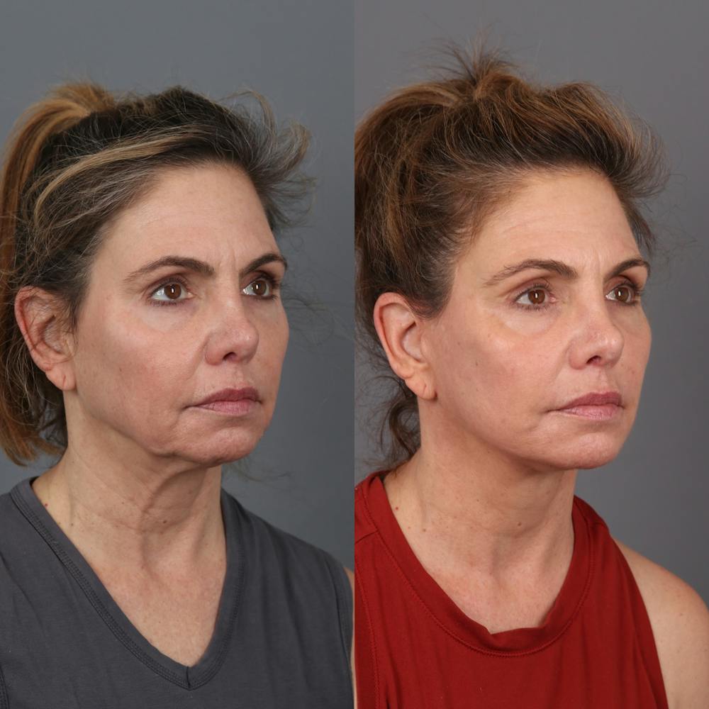 Face & Neck Lift Before & After Gallery - Patient 404364 - Image 1