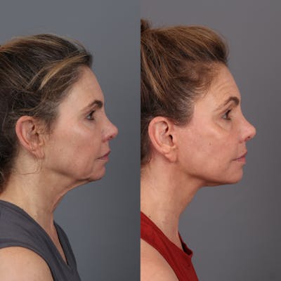 Face & Neck Lift Before & After Gallery - Patient 404364 - Image 2