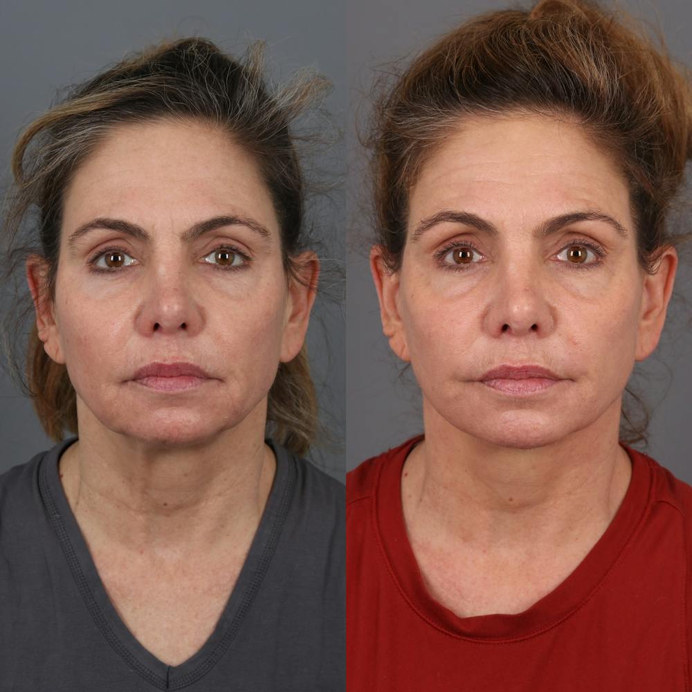 Face & Neck Lift Before & After Gallery - Patient 404364 - Image 3
