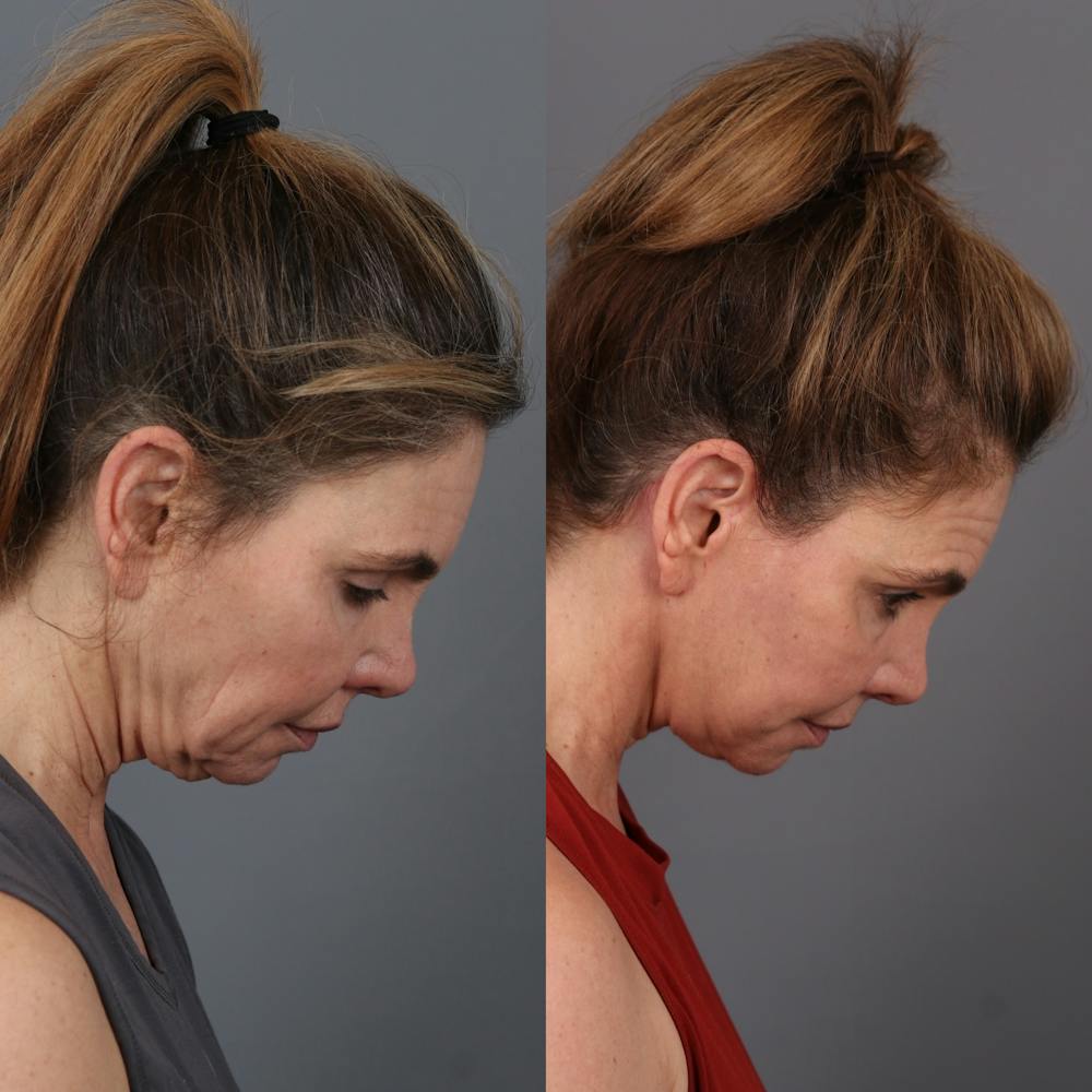 Face & Neck Lift Before & After Gallery - Patient 404364 - Image 4
