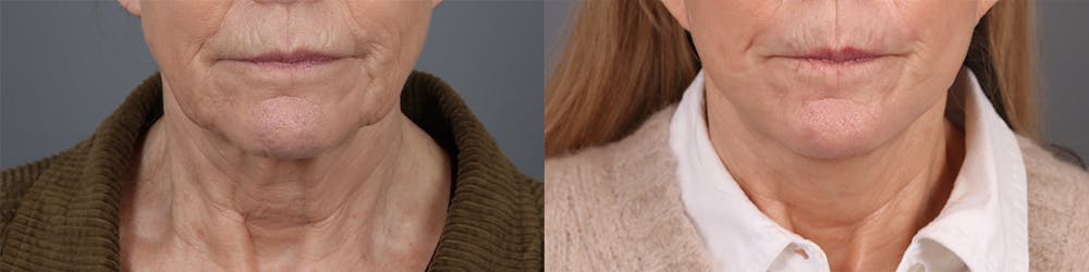 Face & Neck Lift Before & After Gallery - Patient 269276 - Image 1