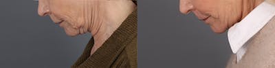 Face & Neck Lift Before & After Gallery - Patient 269276 - Image 4