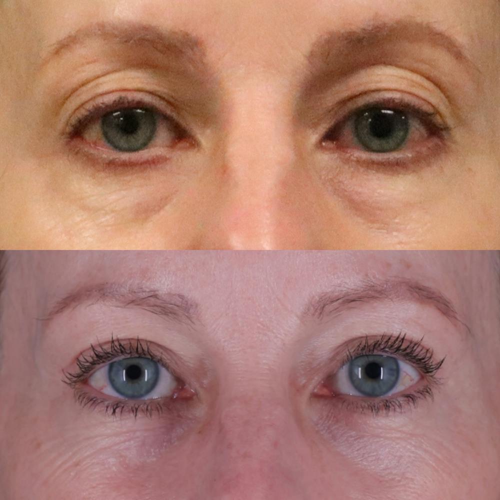 Lower Blepharoplasty Before & After Gallery - Patient 901661 - Image 1