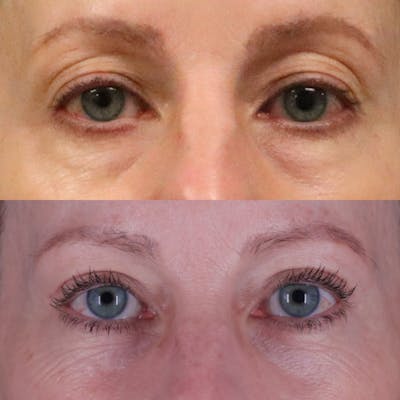 Lower Blepharoplasty Before & After Gallery - Patient 901661 - Image 1