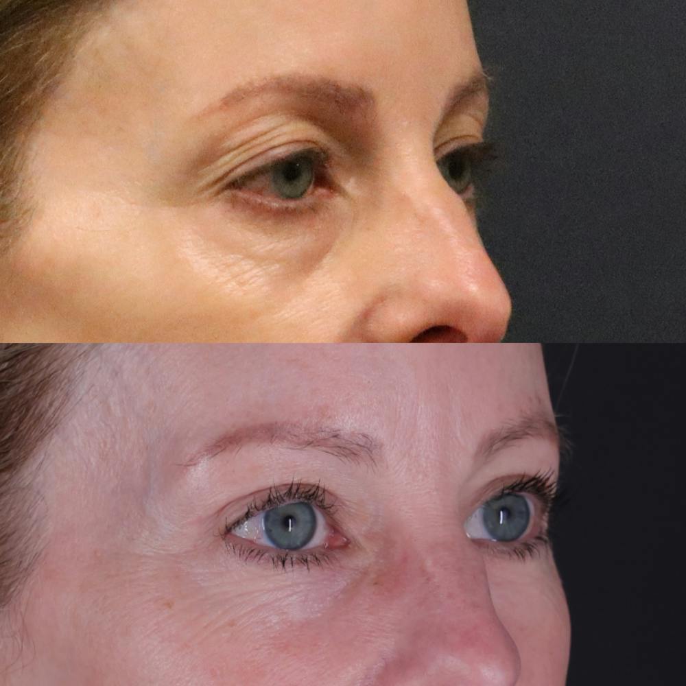 Lower Blepharoplasty Before & After Gallery - Patient 901661 - Image 2