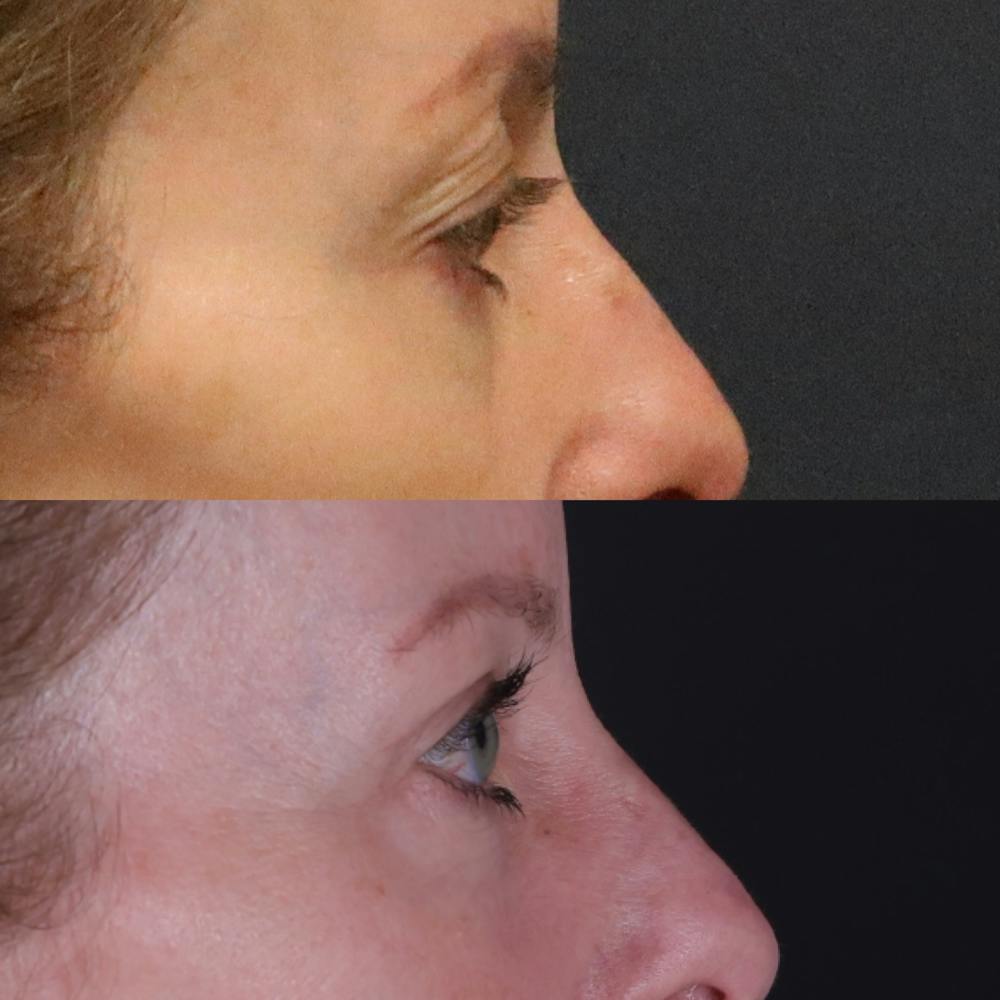 Lower Blepharoplasty Before & After Gallery - Patient 901661 - Image 3