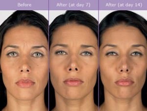 botox before and after