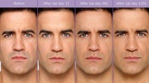 botox before and after