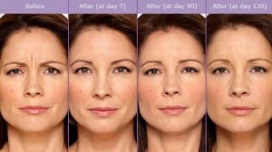 botox before and after