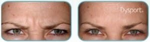 dysport before and after