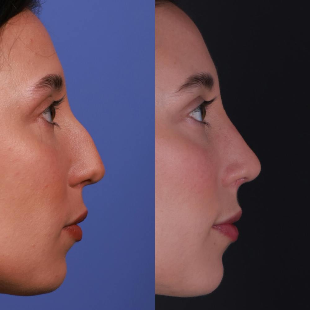 Rhinoplasty Before & After Gallery - Patient 135580 - Image 1