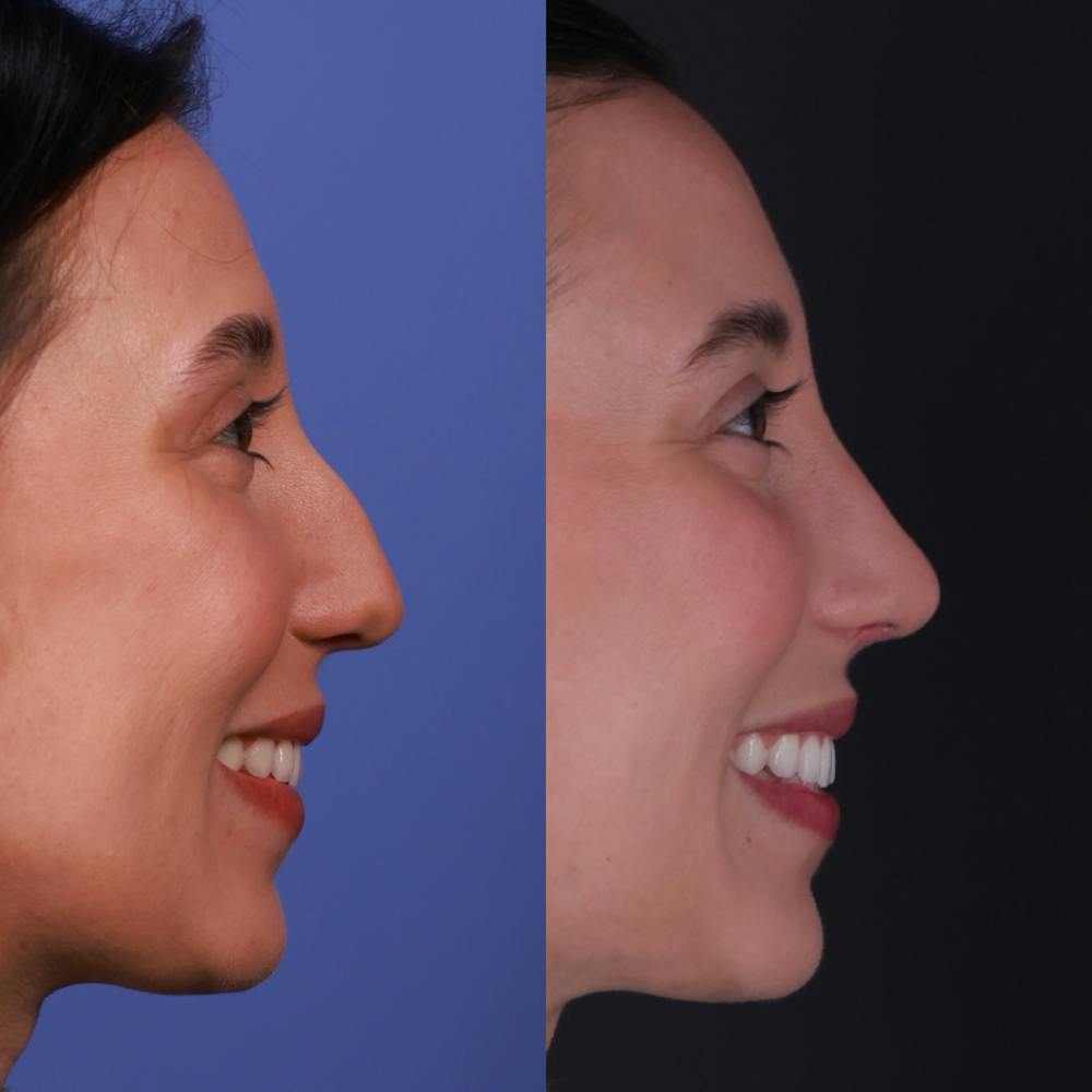 Rhinoplasty Before & After Gallery - Patient 135580 - Image 2