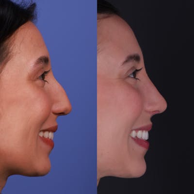 Rhinoplasty Before & After Gallery - Patient 135580 - Image 2