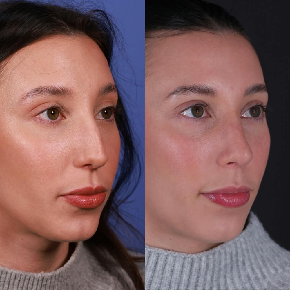 Rhinoplasty Before & After Gallery - Patient 135580 - Image 3