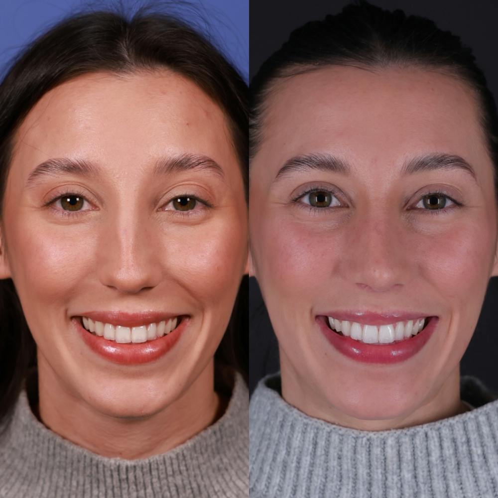 Rhinoplasty Before & After Gallery - Patient 135580 - Image 5