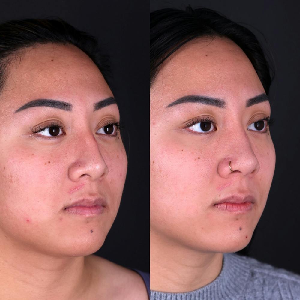 Rhinoplasty Before & After Gallery - Patient 120310 - Image 3