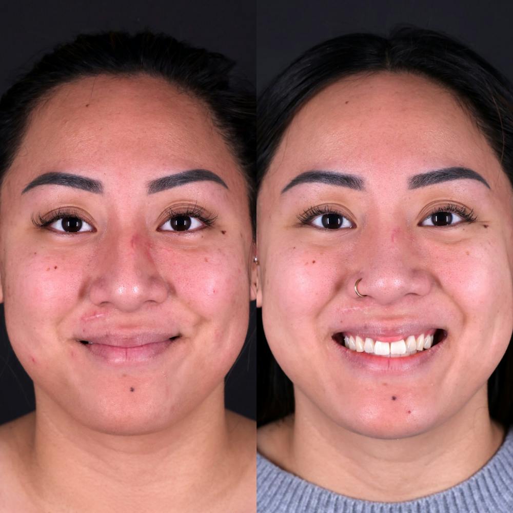 Rhinoplasty Before & After Gallery - Patient 120310 - Image 5