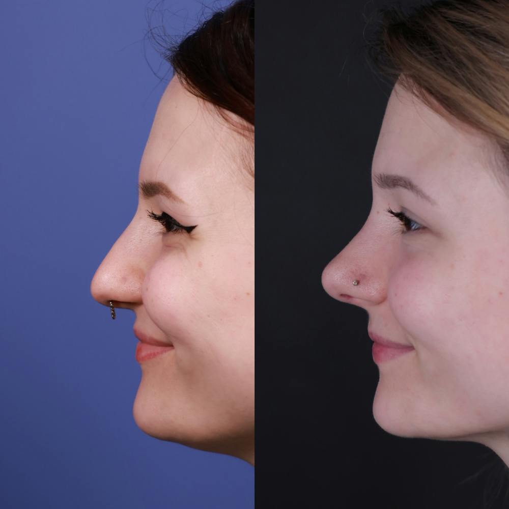 Rhinoplasty Before & After Gallery - Patient 231276 - Image 2