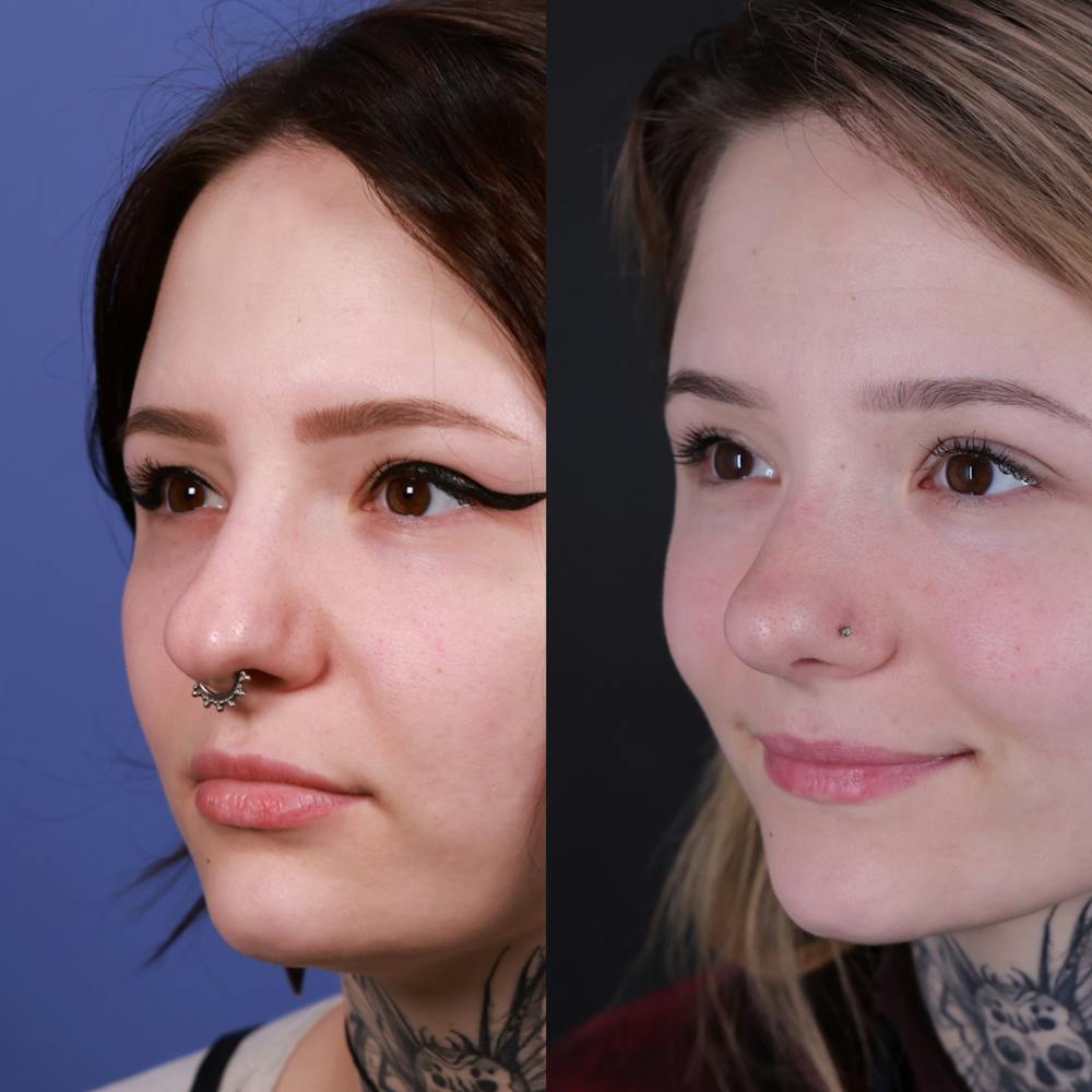 Rhinoplasty Before & After Gallery - Patient 231276 - Image 3