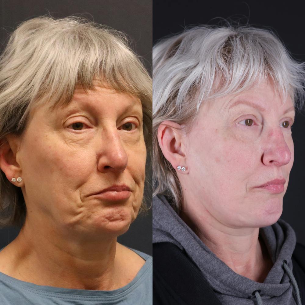 Face & Neck Lift Before & After Gallery - Patient 111877 - Image 1