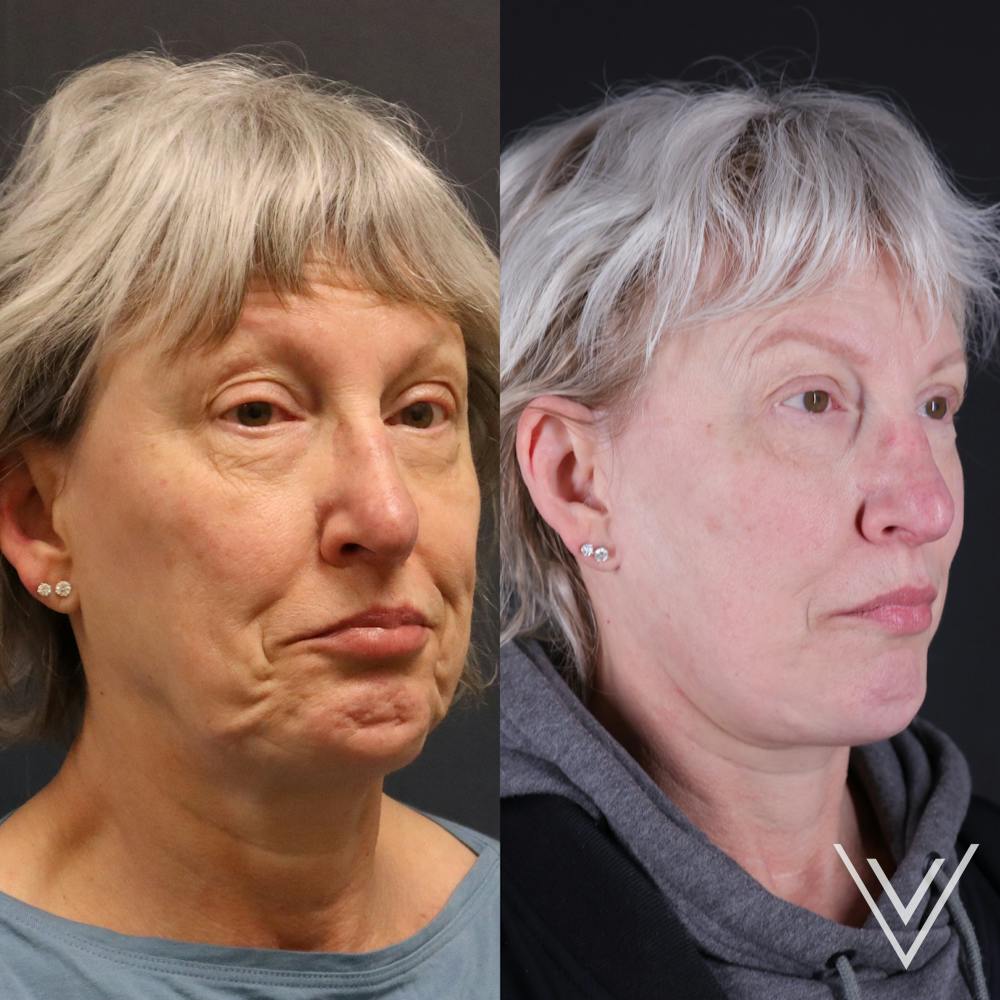 Face & Neck Lift Before & After Gallery - Patient 111877 - Image 1