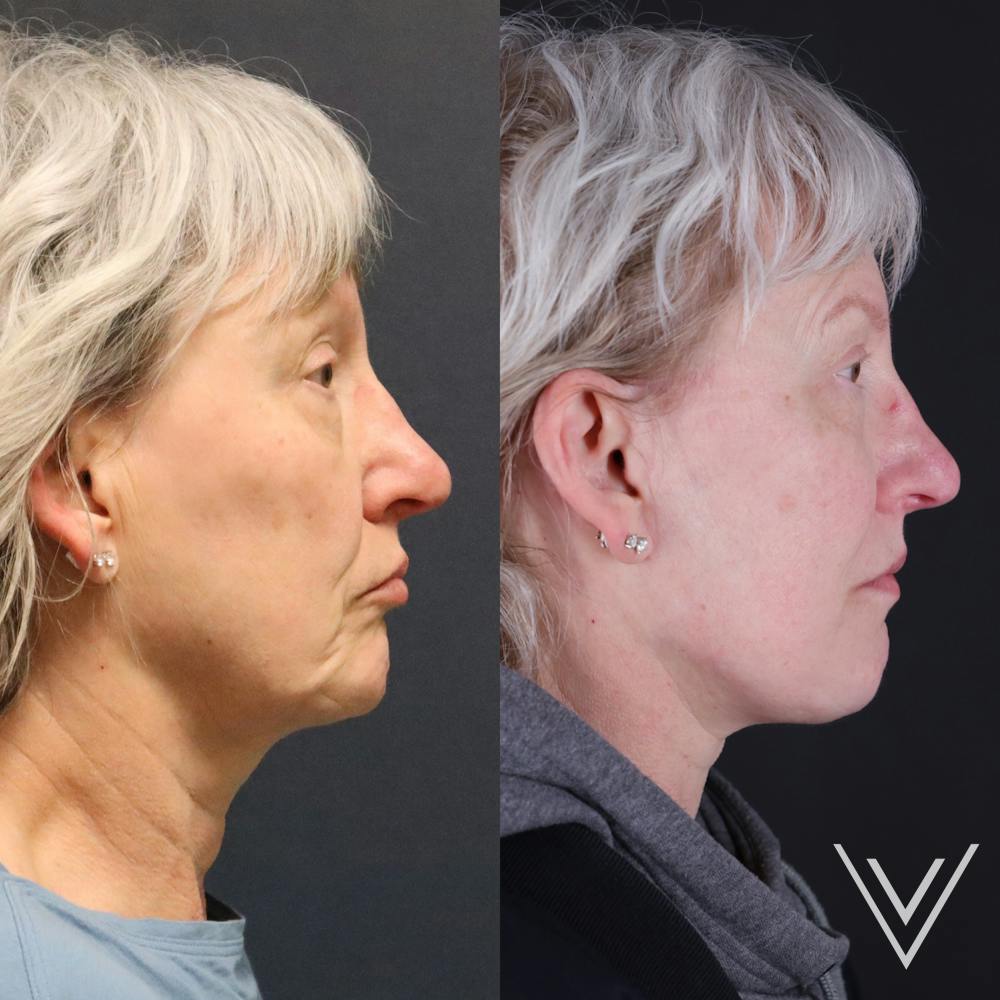 Face & Neck Lift Before & After Gallery - Patient 111877 - Image 2