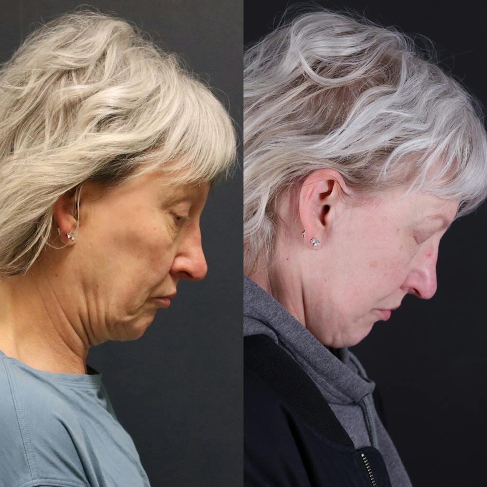 Face & Neck Lift Before & After Gallery - Patient 111877 - Image 3