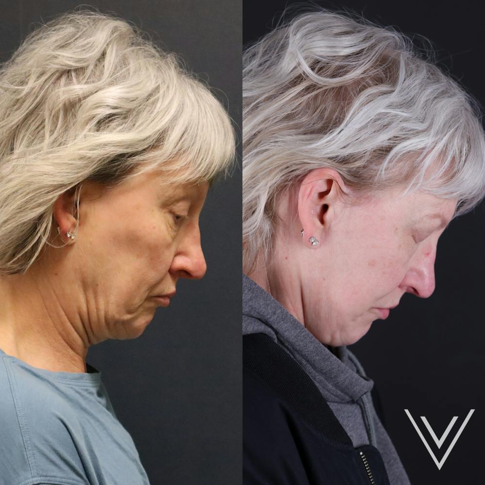 Face & Neck Lift Before & After Gallery - Patient 111877 - Image 3