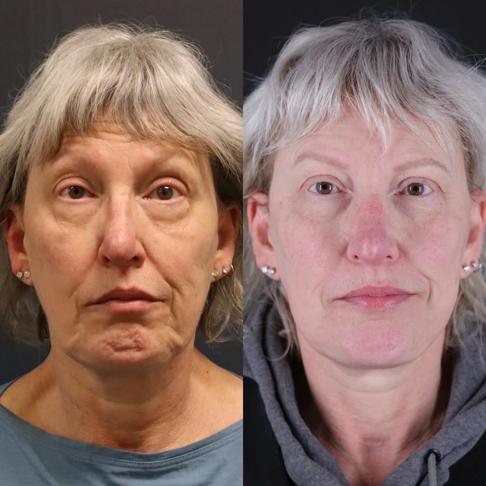 Face & Neck Lift Before & After Gallery - Patient 111877 - Image 4