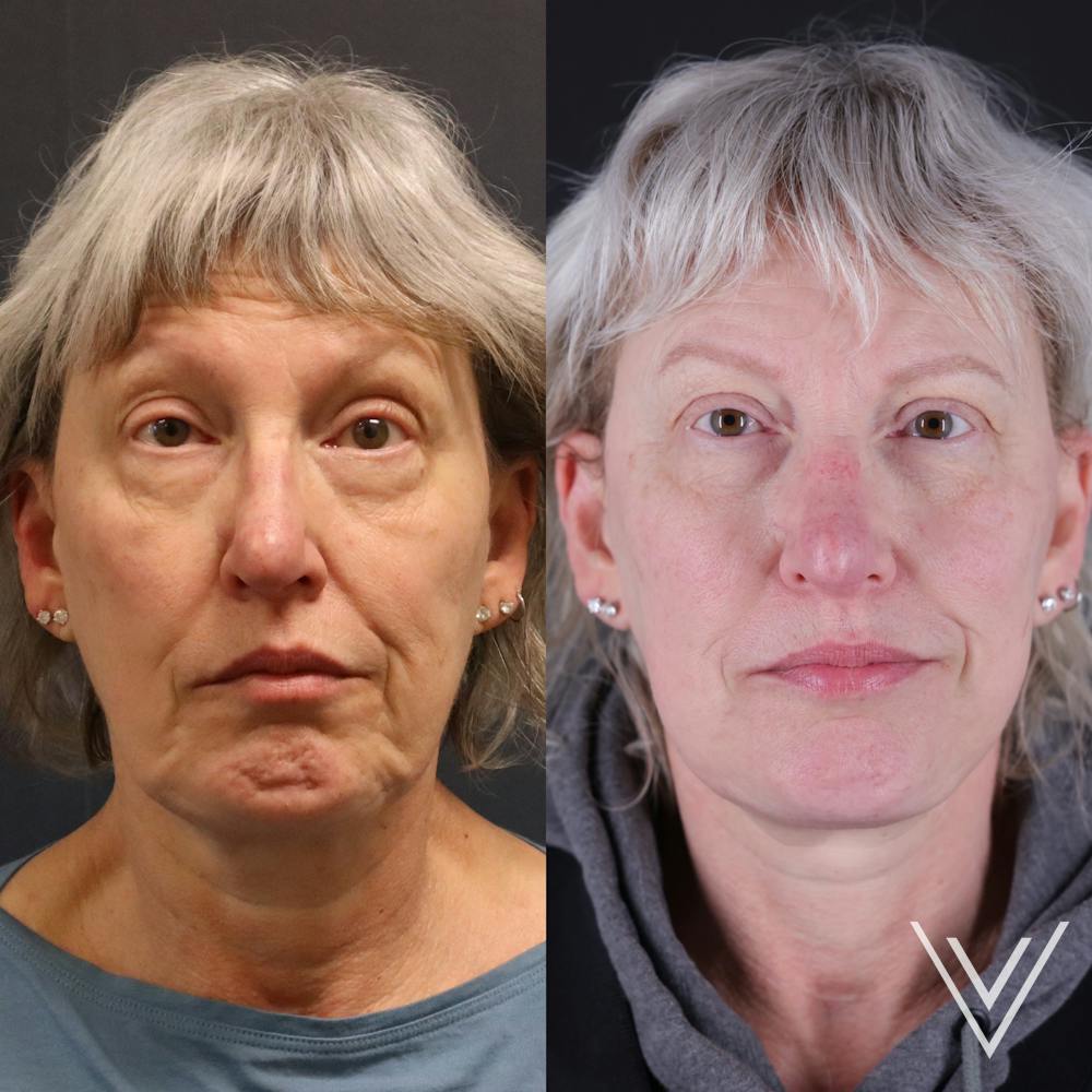 Face & Neck Lift Before & After Gallery - Patient 111877 - Image 4