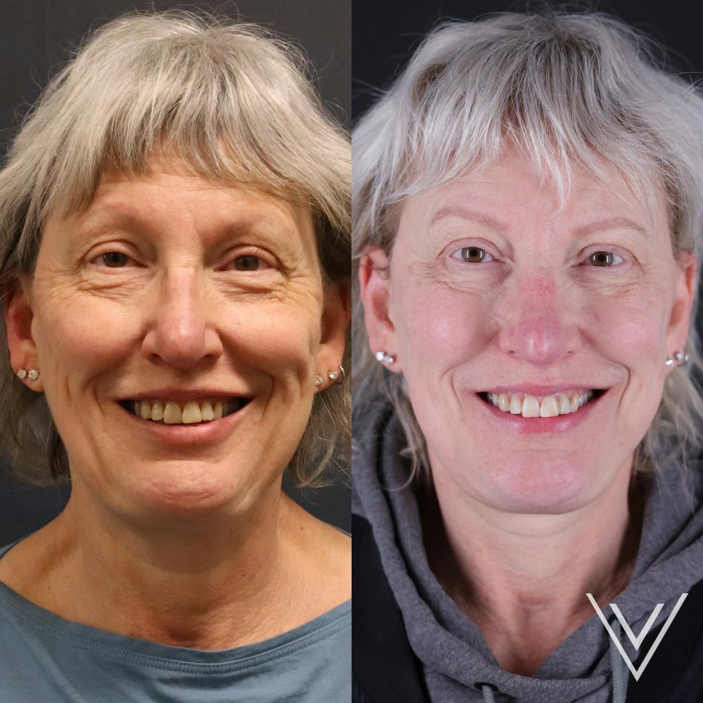 Face & Neck Lift Before & After Gallery - Patient 111877 - Image 5