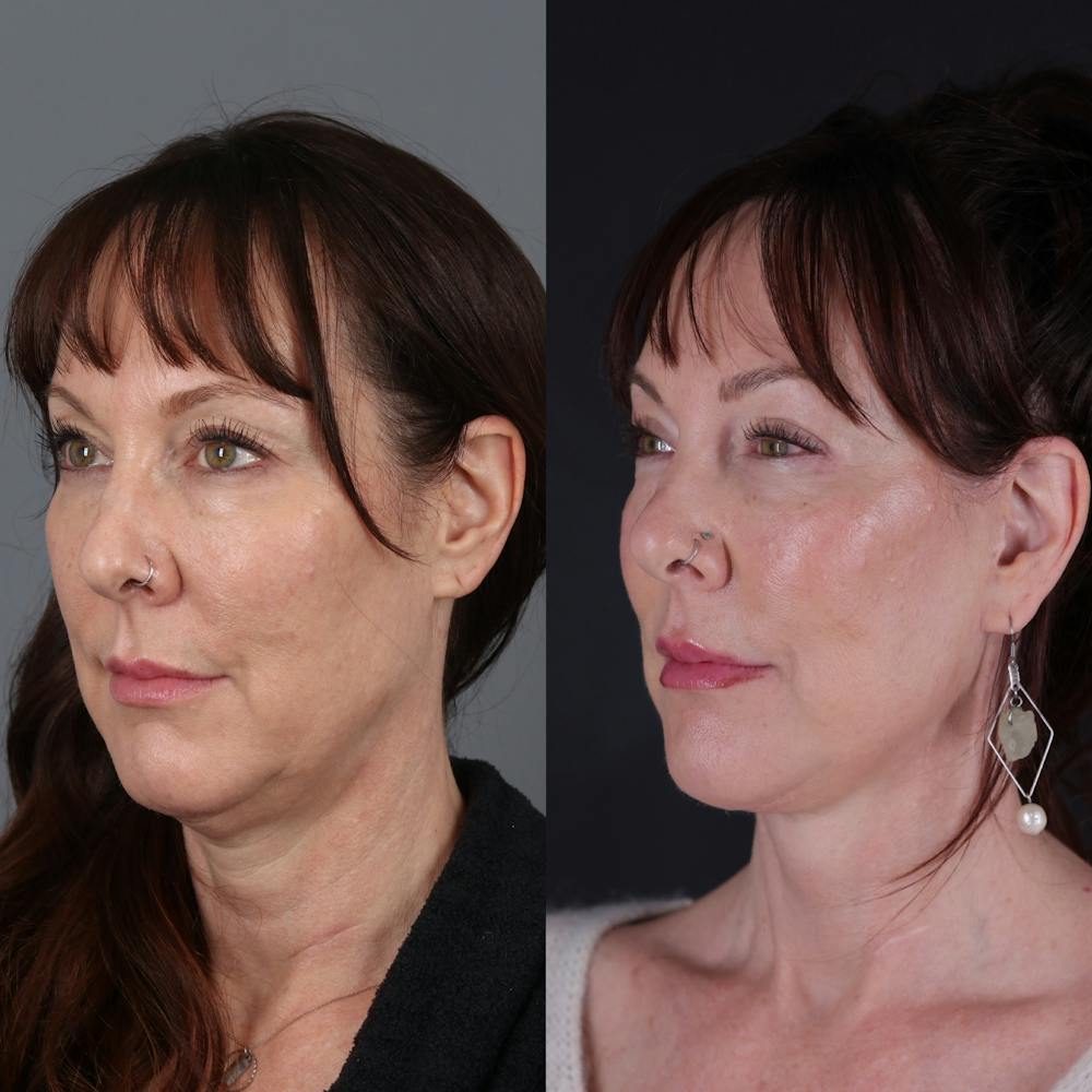 Face & Neck Lift Before & After Gallery - Patient 371836 - Image 1