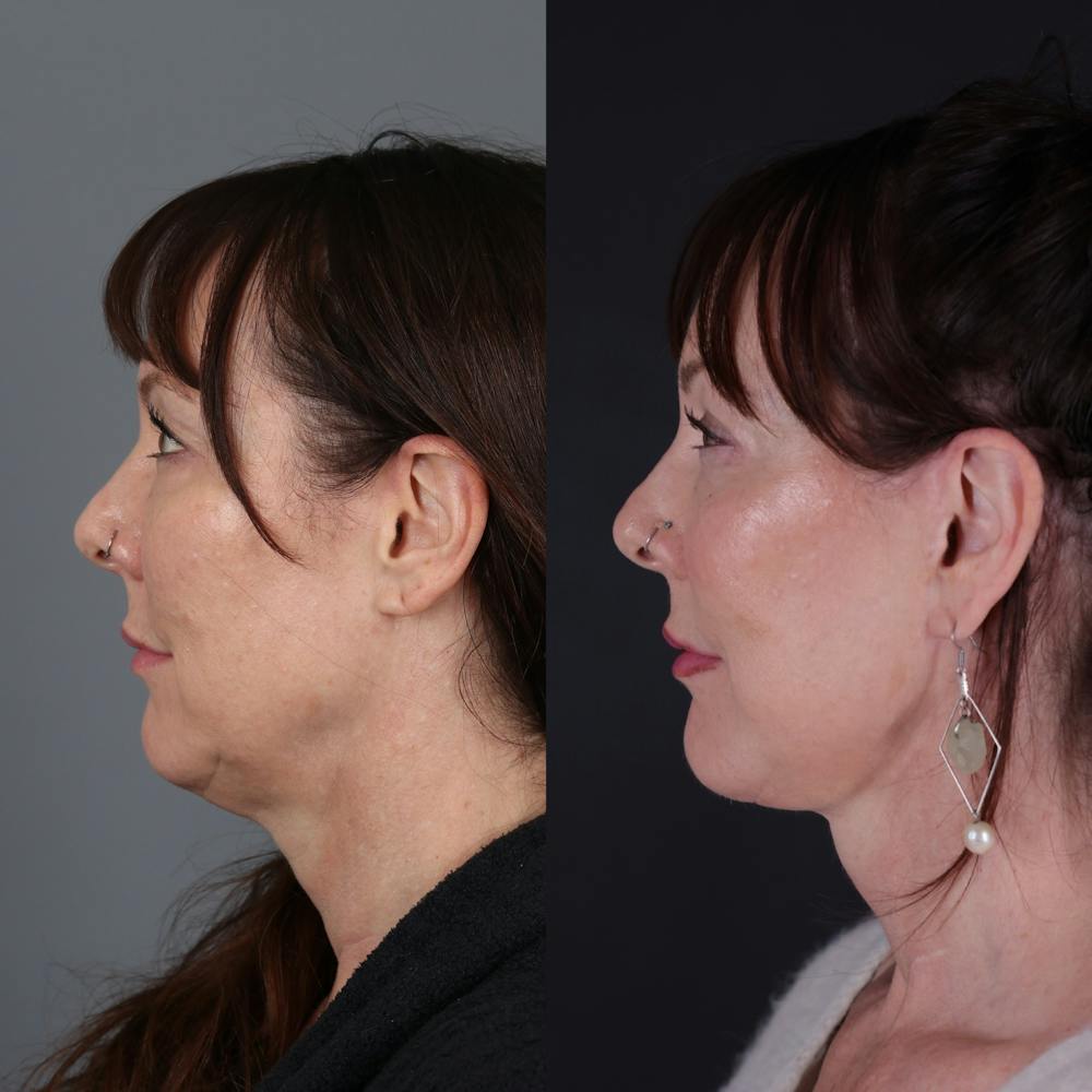 Face & Neck Lift Before & After Gallery - Patient 371836 - Image 2