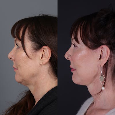 Face & Neck Lift Before & After Gallery - Patient 371836 - Image 2