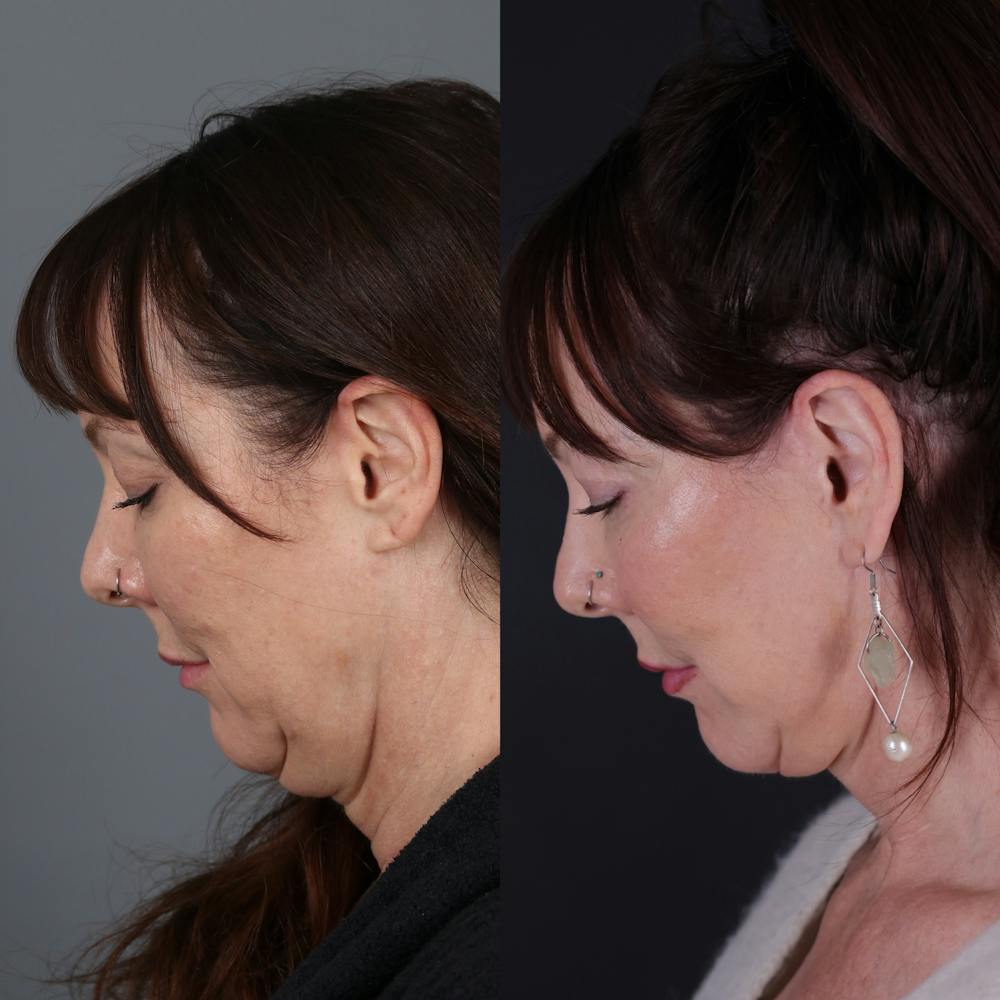 Face & Neck Lift Before & After Gallery - Patient 371836 - Image 3