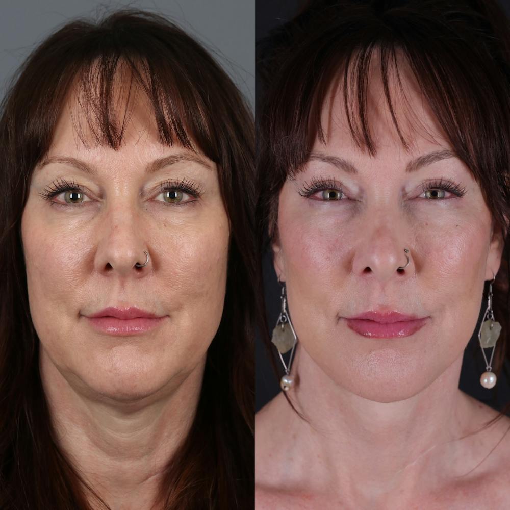 Face & Neck Lift Before & After Gallery - Patient 371836 - Image 4