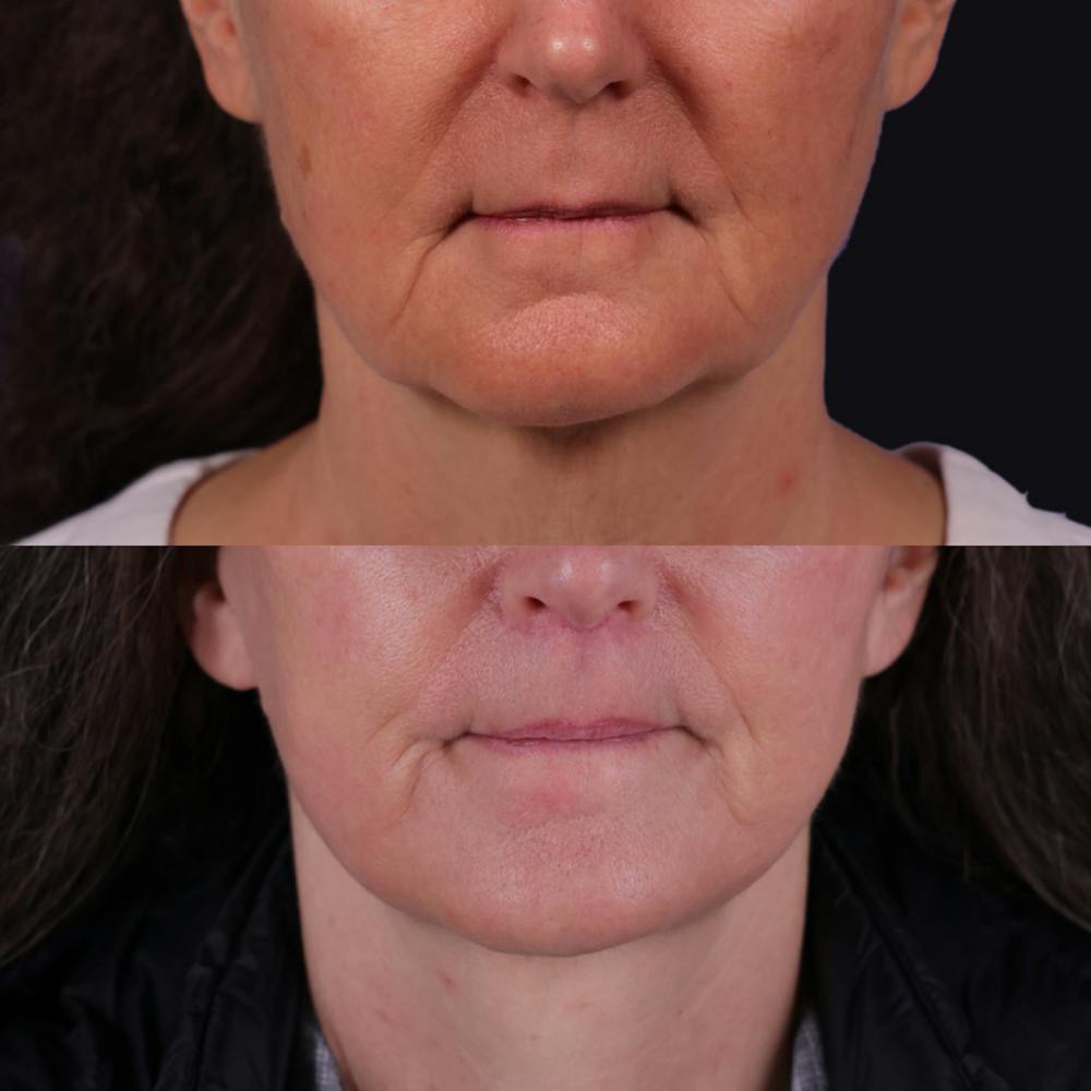 Face & Neck Lift Before & After Gallery - Patient 367512 - Image 3