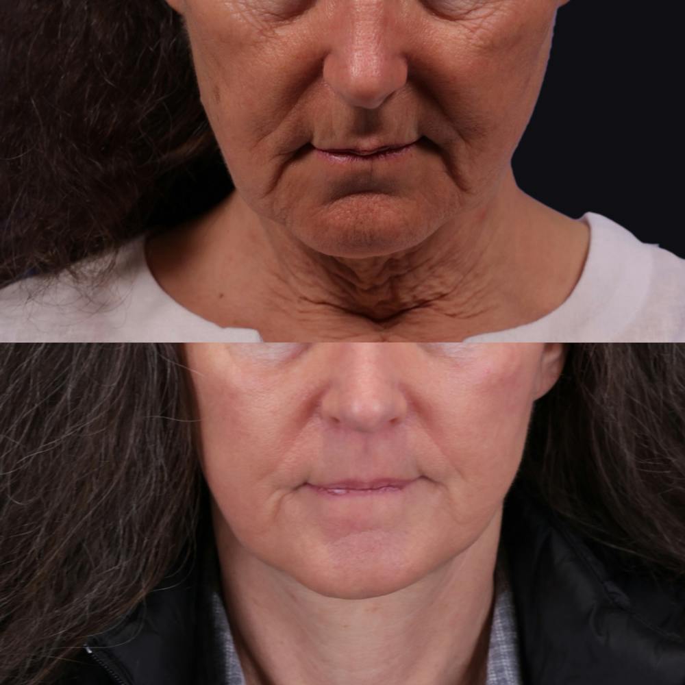 Face & Neck Lift Before & After Gallery - Patient 367512 - Image 4
